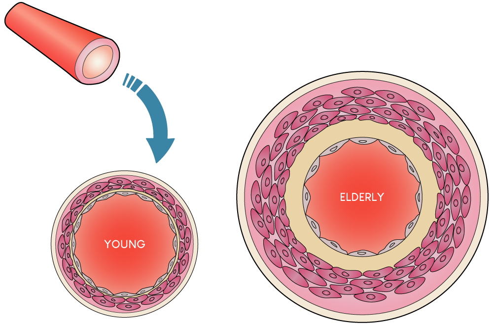 Illustration depicting the effects of endothelial aging, including increased stiffness of the endothelial wall, fat deposition, and narrowing of the blood vessel lumen leading to a higher risk of sub-chronic health conditions.